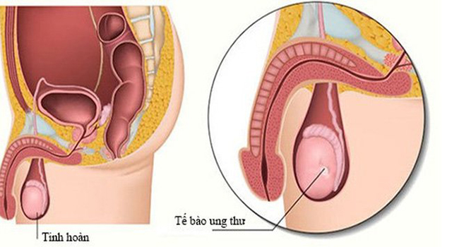 Ung thu tinh hoàn có thể gây ra xuất tinh lẫn máu