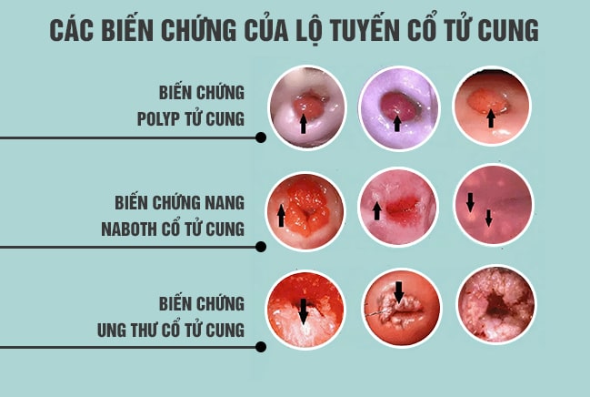 Biến chứng nguy hiểm của viêm lộ tuyến cổ tử cung