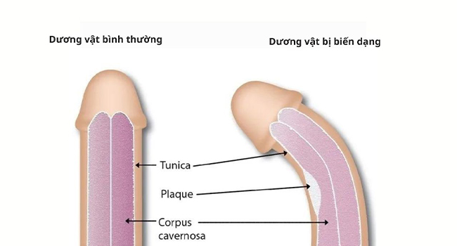 Dài bao quy đầu có thể dẫn đến dương vật bị cong vẹo