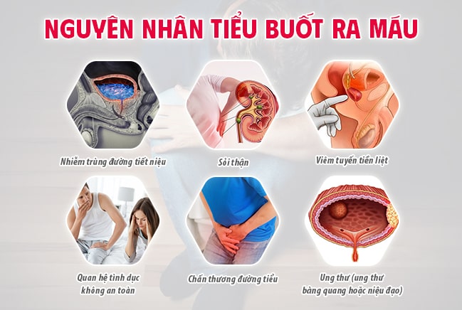 Những nguyên nhân gây tiểu buốt ra máu ở nam giới
