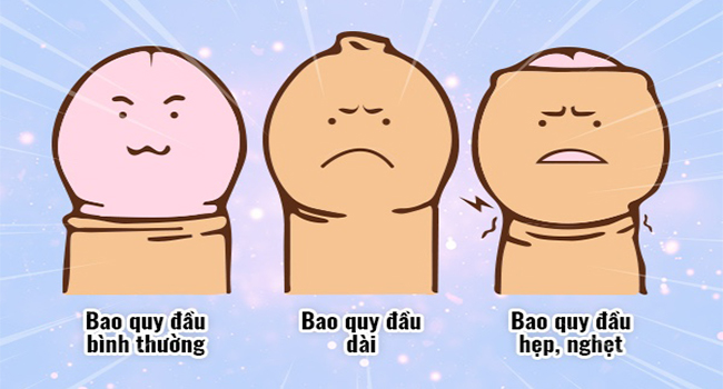 Bao quy đầu dài hoặc hẹp gây khó khăn trong việc vệ sinh, dễ dẫn đến viêm bao quy đầu