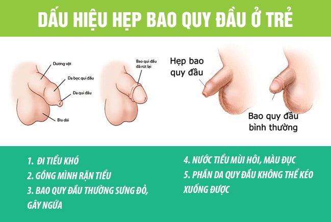 Những dấu hiệu trẻ bị hẹp bao quy đầu