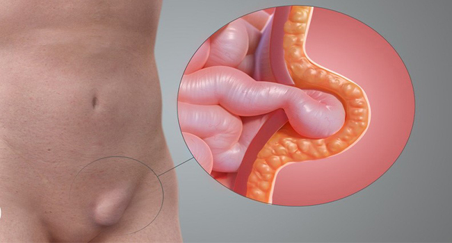 Một trong những nguyên nhân gây sưng bìu tinh hoà là thoát vị bẹn