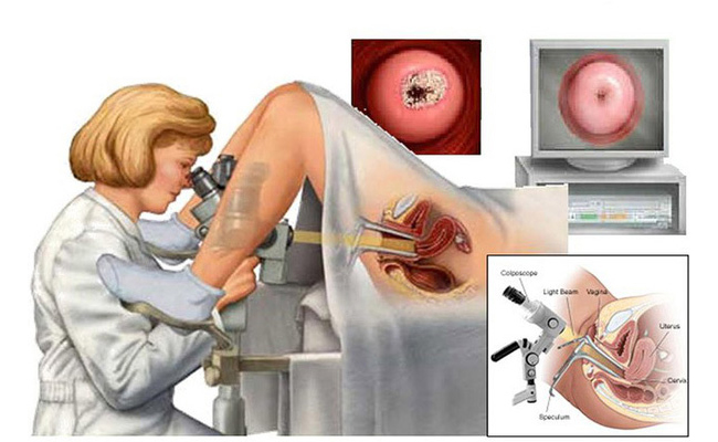Đốt viêm lộ tuyến cổ tử cung