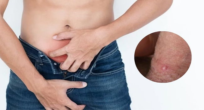 Ngứa rát, nổi mụn nhỏ li ti hoặc mụn nước là dấu hiệu của nổi mụn dương vật