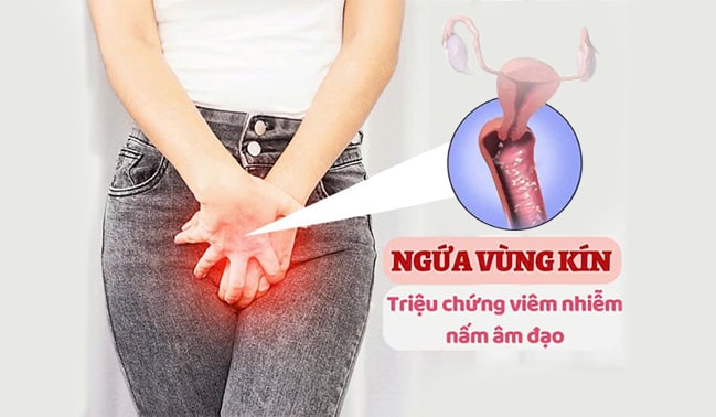 Bị ngứa ở mép vùng kín do nấm âm đạo