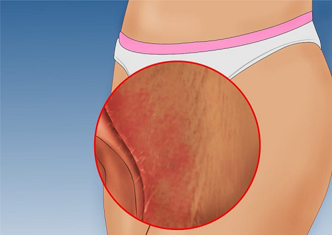 Bị viêm âm đạo khiến vùng kín ngứa rát, sưng đỏ