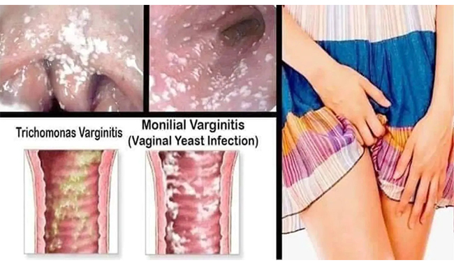 Khí hư bất thường là dấu hiệu viêm âm đạo phổ biến nhất