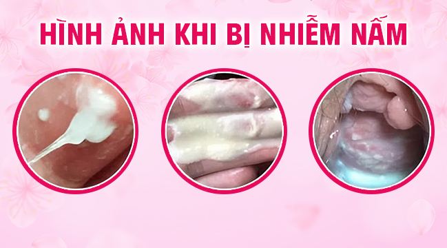 Ngứa vùng kín là dấu hiệu nhiễm nấm
