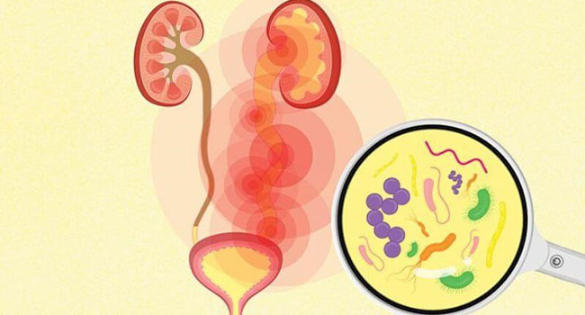 Một trong những nguyên nhân gây tiểu buốt là nhiễm trùng đường tiết niệu