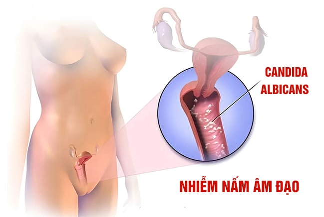 Viêm nấm Candida là một dạng viêm nhiễm phụ khoa rất phổ biến