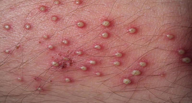 Nguyên nhân nổi mụn dương vật ở nam giới có thể do viêm nang lông