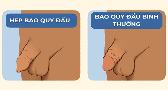 Hẹp bao quy đầu là tình trạng bao quy đầu vẫn không thể tuột xuống và bó chặt đầu dương vật