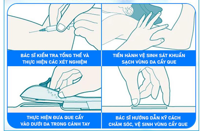 Quy trình cấy que tránh thai an toàn