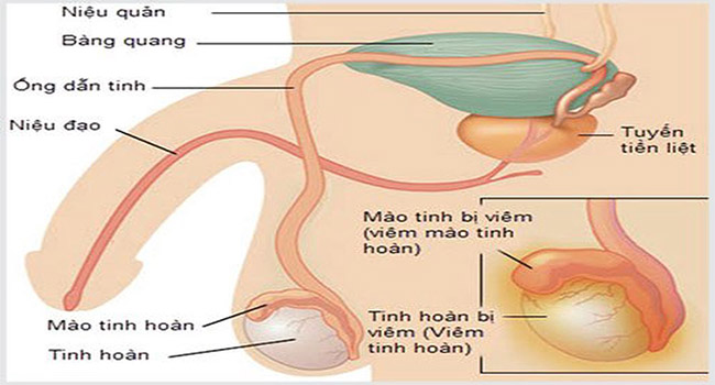 Nguyên nhân vsuwng bìu tinh hoàn do viêm mào tinh hoàn