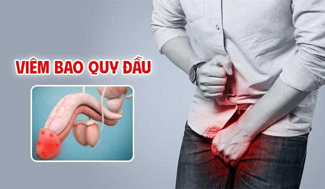 Viêm bao quy đầu là một trong những bệnh lý nam khoa thường gặp ở nam giới