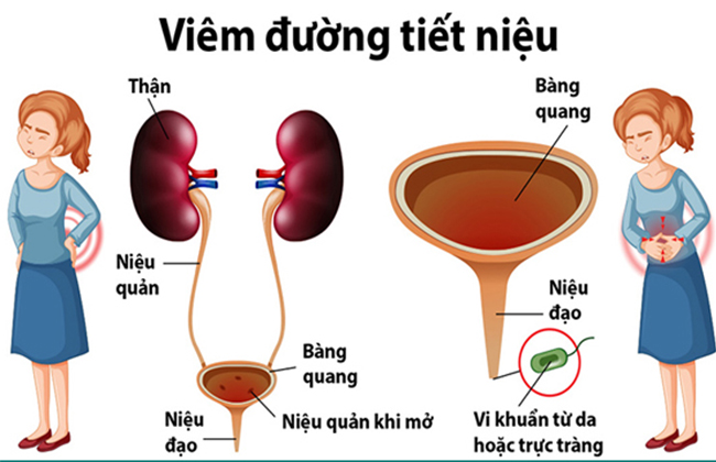 Viêm đường tiết niệu ở nữ giới