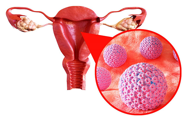 virus HPV (Human Papillomavirus) là nguyên nhân chính gây ra viêm cổ tử cung