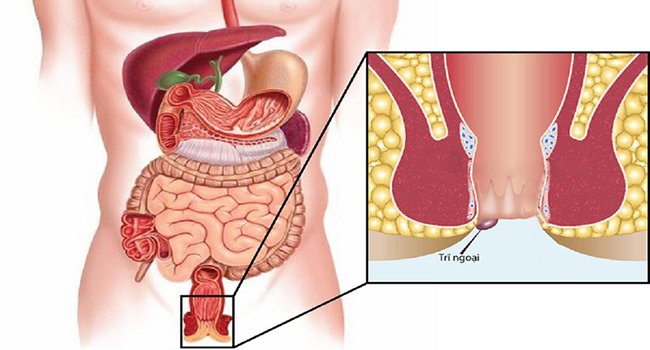 Hình ảnh trĩ ngoại độ 2 với búi trĩ phình to hơn và xuất hiện rõ rệt quanh rìa hậu môn