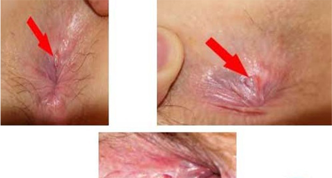 Ảnh nứt kẽ hậu môn