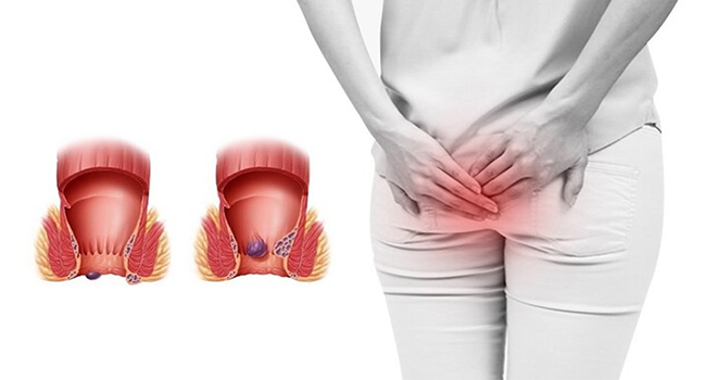 Bạn nên đi khám trĩ khi có triệu chứng ngứa, rát vùng hậu môn, chảy máu khi đại tiện