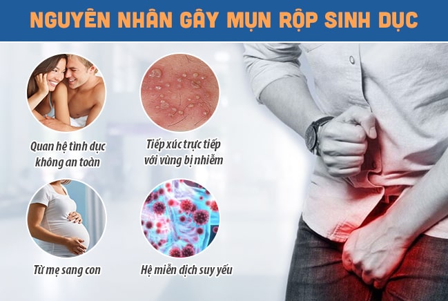 Các con đường chính lây mụn rộp sinh dục