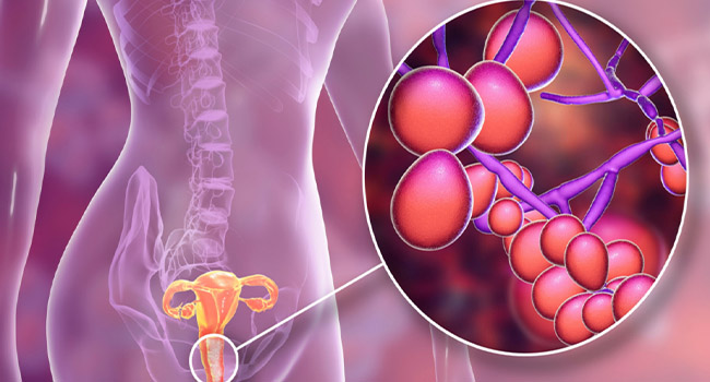 Nguyên nhân phổ biến gây ngứa vùng kín ở nữ là nhiễm nấm Candida