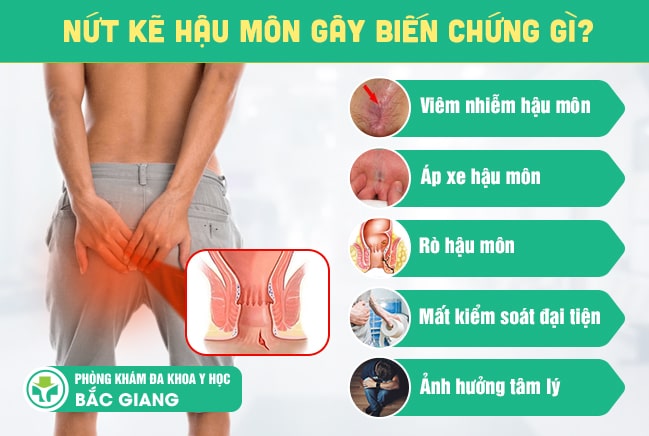 Nứt kẽ hậu môn gây nhiều biến chứng nguy hiểm
