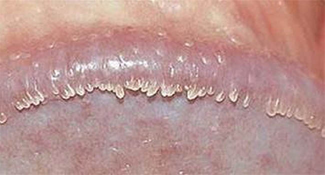 Dấu hiệu hạt ngọc dương vật là có các mụn nhỏ li ti màu trắng ngà, hồng nhạt