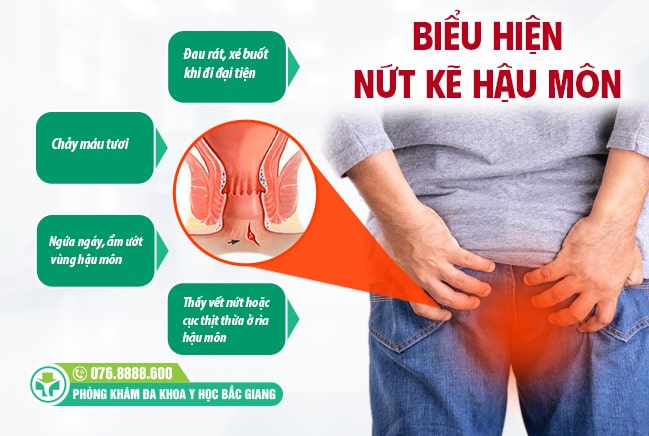 Những triệu chứng nứt kẽ hậu môn