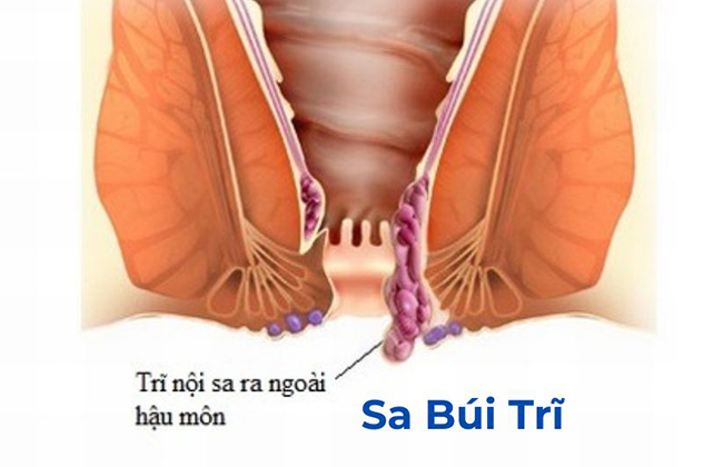 Sa búi trĩ là một trong những dấu hiệu trĩ nội thường gặp