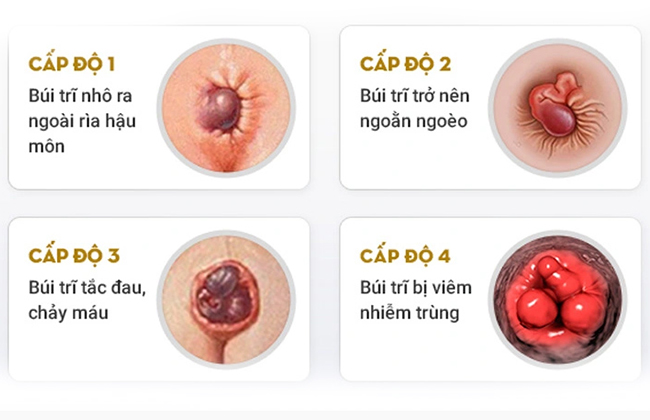Trĩ nội được chia thành 4 độ