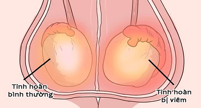 Nam giới bị viêm tinh hoàn có thể gây sưng bìu bên phải