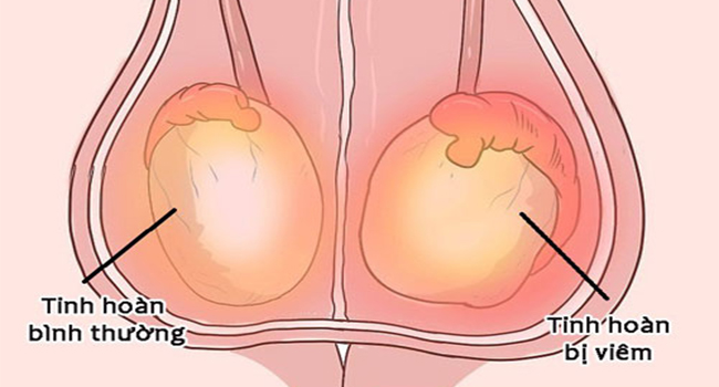 Nam giới bị đau tinh hoàn có thể là do viêm tinh hoàn