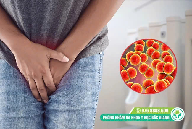 Nam giới đi tiểu buốt có mủ có thể là biểu hiện của bệnh lậu