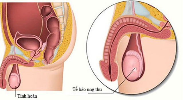 Ung thư tinh hoàn khiến bìu sưng to, cảm giác đau và nặng nề