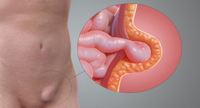 Nguyên nhân nam giới bị đau tinh hoàn có thể do thoát vị bẹn