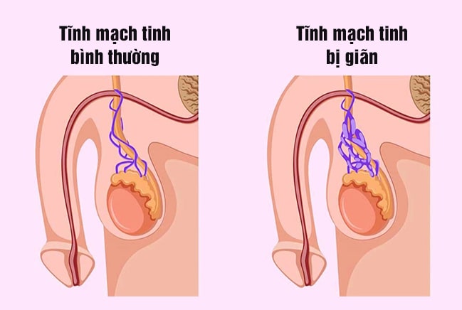 Giãn tĩnh mạch thừng tinh cũng là nguyên nhân gây sưng bìu bên phải