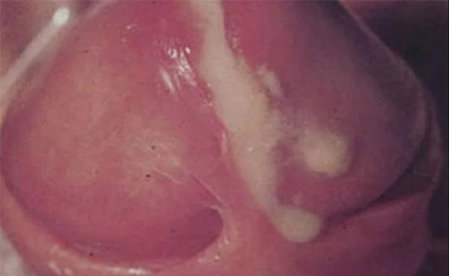 Dương vật chảy mủ là dấu hiệu đặc trưng của bệnh lậu