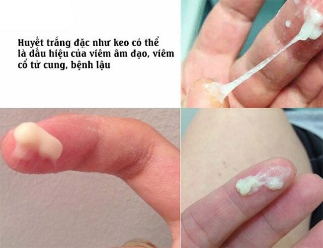 Dấu hiệu bệnh lậu ở nữ