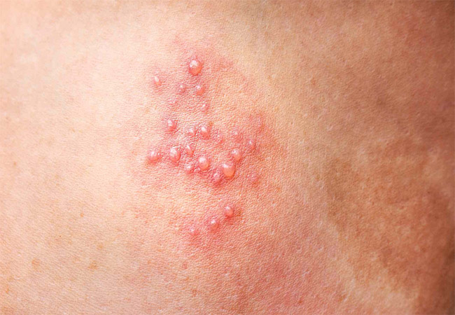 Nam giới bị mụn rộp sinh dục cũng biểu hiện bằng những nốt mụn bất thường ở dương vật