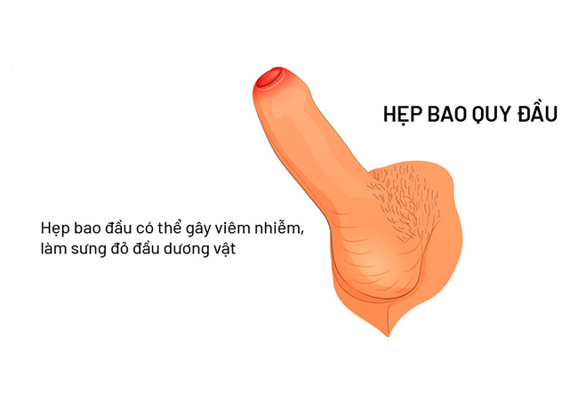 Hẹp bao quy đầu gây sưng đỏ đầu dương vật