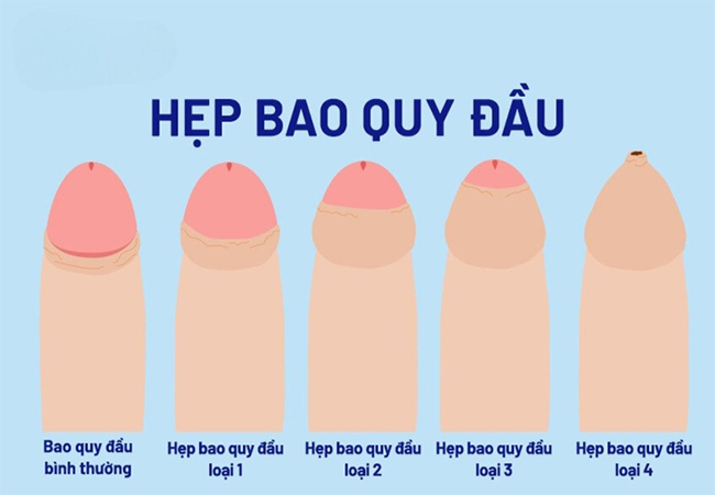 Dấu hiệu hẹp bao quy đầu ở nam giới